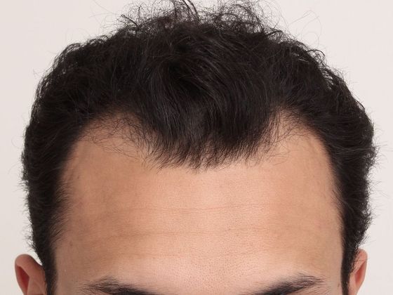 Male Before And After Hair Transplant Photos Hairline FUT (6) - Before