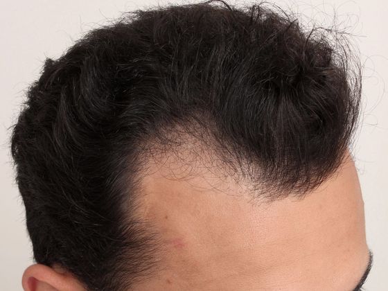 Hair Transplant - Male: Hairline FUT - Case 38 - Before FUT hair transplant