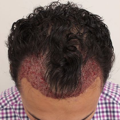 Hair Transplant - Male: Hairline FUT - Case 38 - Post-op FUT hair transplant