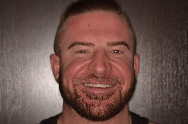 Smile Design: Case 8 - Before Porcelain veneers