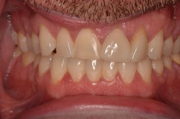 Smile Design: Case 8 - Before dental treatment of worn teeth from bruxism