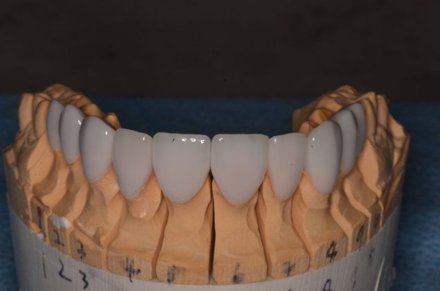 Smile Design: Case 8 - Porcelain veneers in lab