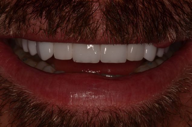 Smile Design: Case 8 - After insertion of porcelain veneers