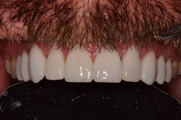 Smile Design: Case 8 - After smile design