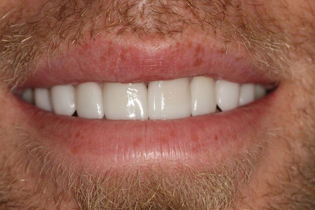 Smile Design: Case 9 - After smile