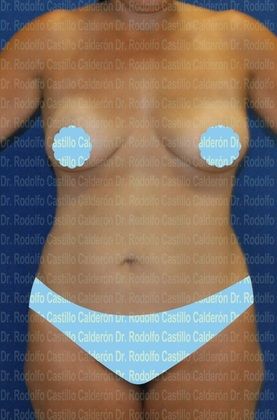 Mommy Makeover -Abdomen, Breast, Lipo, BBL-: TT + Breast lift w/implant change + liposculpture - Before