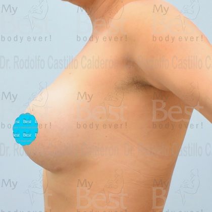 Breast Augmentation: Breast Augmentation 2009-2020 - After