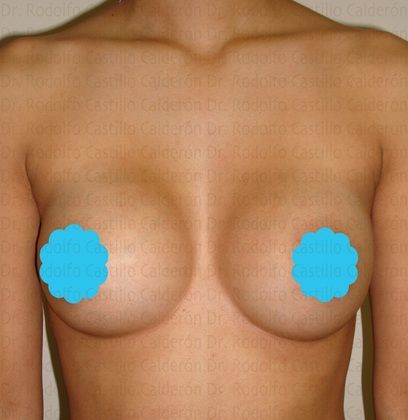 Breast Augmentation: Breast Augmentation 5 - After