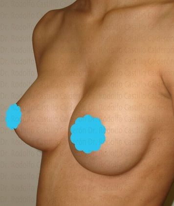 Breast Augmentation: Breast Augmentation 5 - After