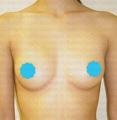 Breast Augmentation: Breast Augmentation 5 - Before