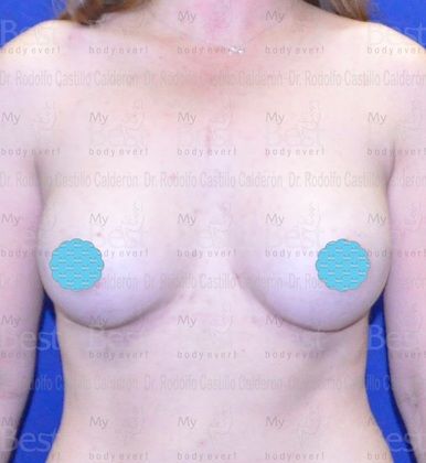 Breast Augmentation: Breast Augmentation 6 - After