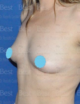 Breast Augmentation: Breast Augmentation 6 - Before