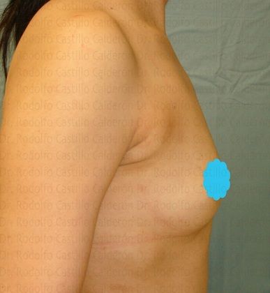Breast Augmentation: Breast Augmentation 7 - Before