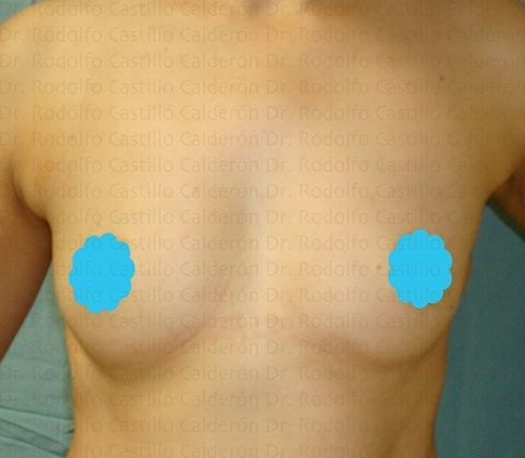 Breast Augmentation: Breast Augmentation 7 - Before