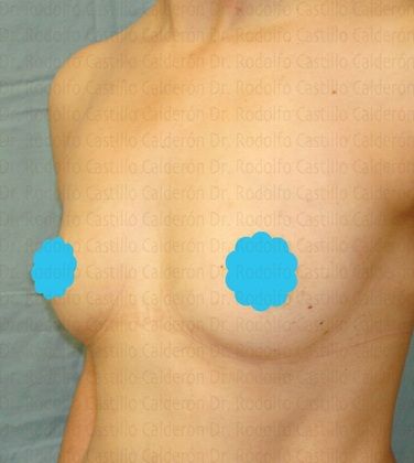 Breast Augmentation: Breast Augmentation 7 - Before