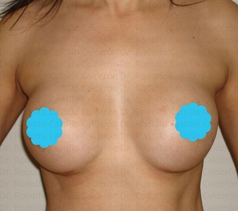 Breast Augmentation: Breast Augmentation 7 - After