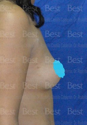 Breast Augmentation: Breast Augmentation 8 - Before