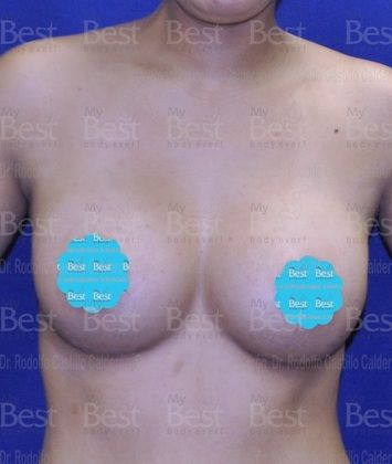 Breast Augmentation: Breast Augmentation 8 - After