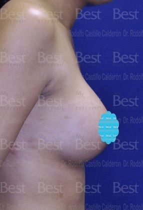 Breast Augmentation: Breast Augmentation 8 - After