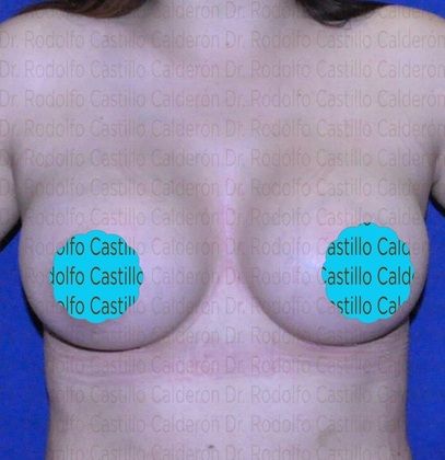 Breast Augmentation: Breast Augmentation 10 - After