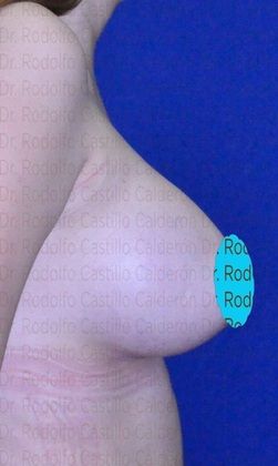 Breast Augmentation: Breast Augmentation 10 - After