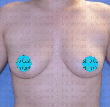 Breast Augmentation: Breast Augmentation 10 - Before