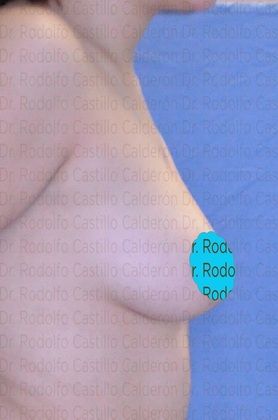 Breast Augmentation: Breast Augmentation 10 - Before