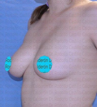Breast Augmentation: Breast Augmentation 10 - Before