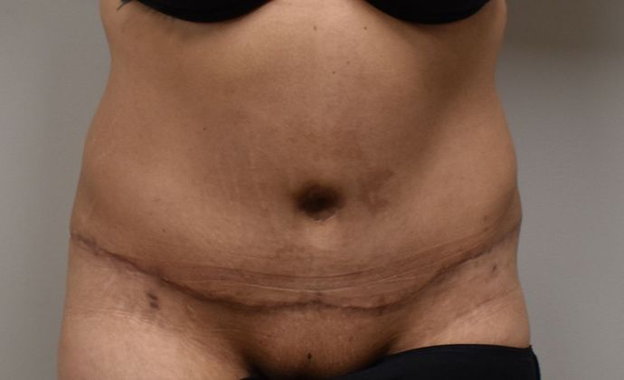 Tummy Tuck (Abdominoplasty): Case 248 - After