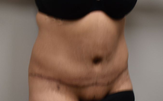 Tummy Tuck (Abdominoplasty): Case 248 - After