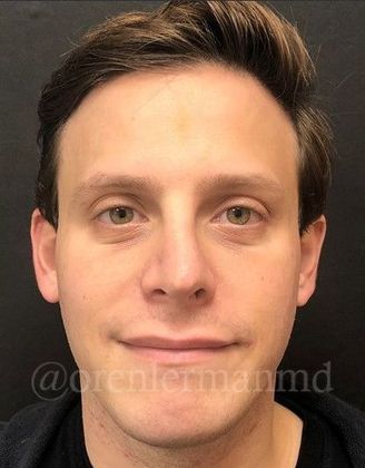 Rhinoplasty: Case 1 - After