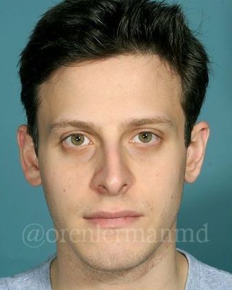 Rhinoplasty: Case 1 - Before