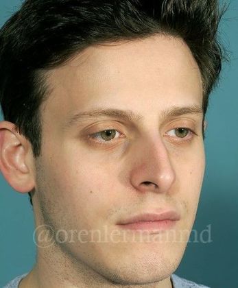 Rhinoplasty: Case 1 - Before