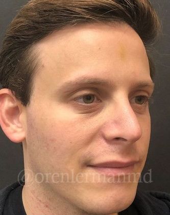 Rhinoplasty: Case 1 - After