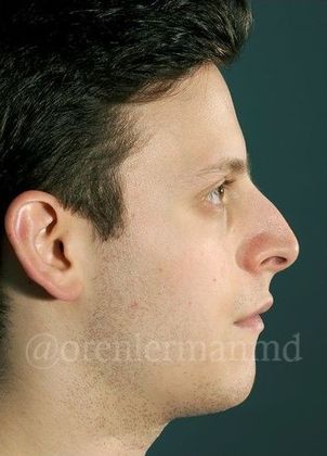 Rhinoplasty Case 1 - Before