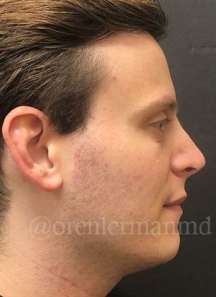 Rhinoplasty Case 1 - After