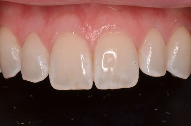 Porcelain Veneers: Case 22 - Before Porcelain veneers