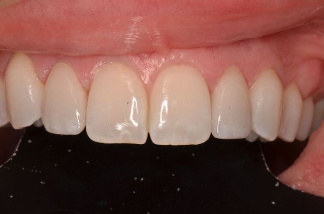 Porcelain Veneers: Case 22 - After Porcelain veneers