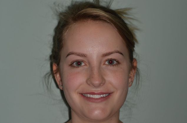 Porcelain Veneers: Case 22 - Before Porcelain veneers