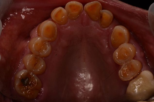 Acid Erosion of teeth due to gastric reflex Case 1 - Before