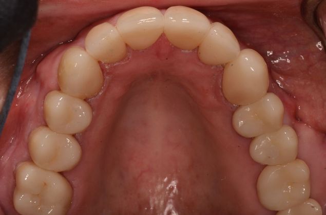 Acid Erosion of teeth due to gastric reflex Case