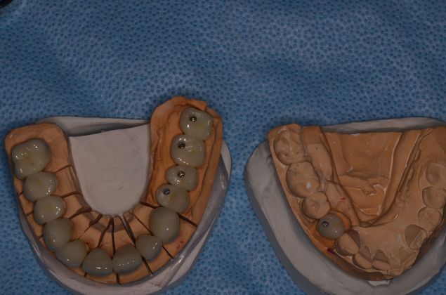 Acid Erosion of teeth due to gastric reflex: Case 1 - Lab work of the porcelain crowns before they were inserted in the patient