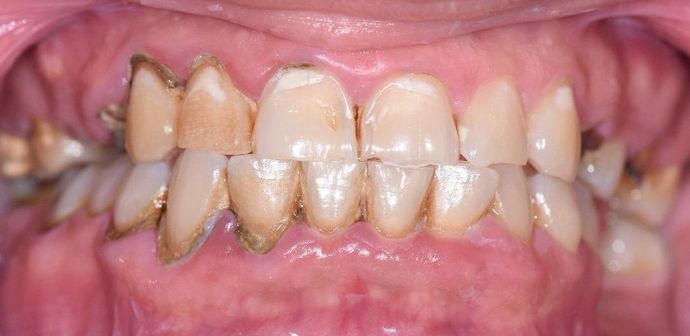 Periodontal Cleaning: Case 10 - Victoria, TX - Before