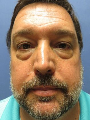 Eyelid Surgery (Blepharoplasty) Case 3 - Before