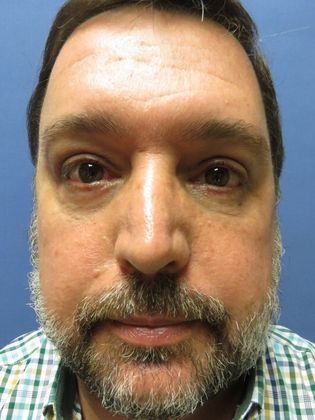 Eyelid Surgery (Blepharoplasty) Case 3 - After