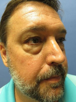 Eyelid Surgery (Blepharoplasty): Case 3 - Before