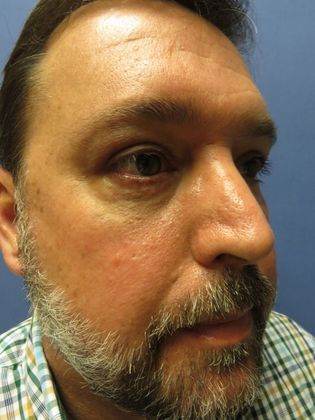 Eyelid Surgery (Blepharoplasty): Case 3 - After