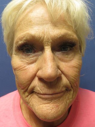 Laser Skin Resurfacing: Case 1 - Before