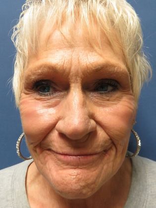 Laser Skin Resurfacing: Case 1 - After