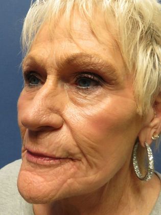 Laser Skin Resurfacing Case 1 - After